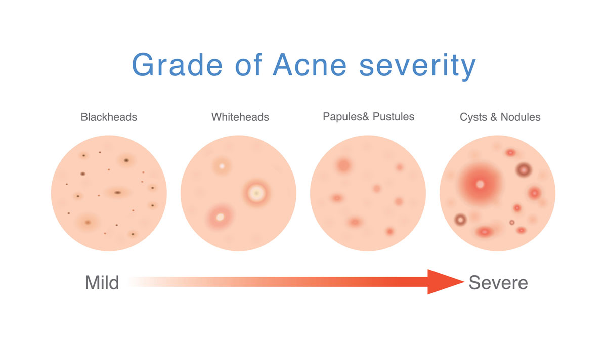 What Does Normal Acne Look Like At Jeannie Wilson Blog