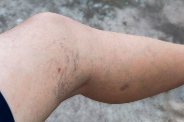 Grimsby Vein Laser Treatment