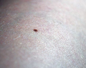 Mole Removal Clinic Hamilton