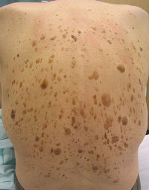 Seborrheic keratosis Removal Clinic Hamilton