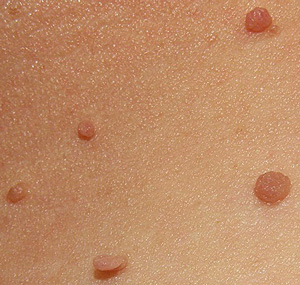 Skin Tag Removal Clinic Hamilton